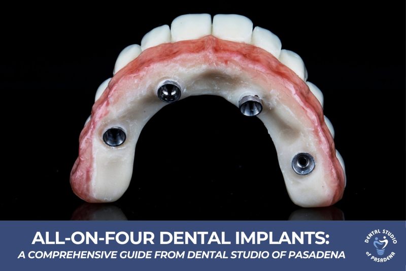 All-On-Four Dental Implants A Comprehensive Guide from Dental Studio of Pasadena New