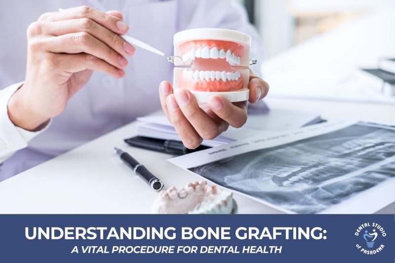 Understanding Bone Grafting A Vital Procedure for Dental Health New